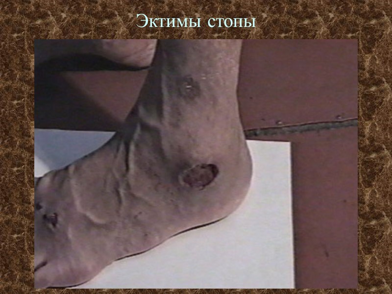 Эктимы стопы